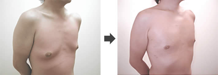 女性化乳房修正術症例№01before-after正面