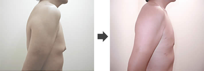 女性化乳房修正術症例№01before-after右斜め