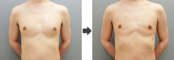 女性化乳房修正術症例№20before-after正面