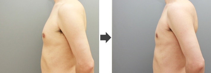 女性化乳房修正術症例№20before-after左向き