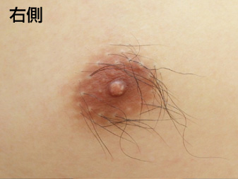 女性化乳房修正術症例№20術前右側乳輪乳頭の状態