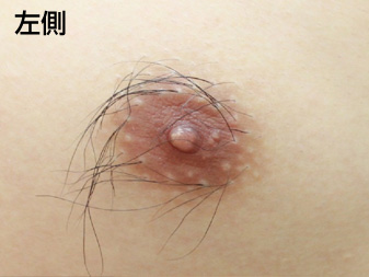 女性化乳房修正術症例№20術前左側乳輪乳頭の状態