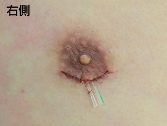 女性化乳房修正術症例№20手術直後右側ドレーン挿入の状態