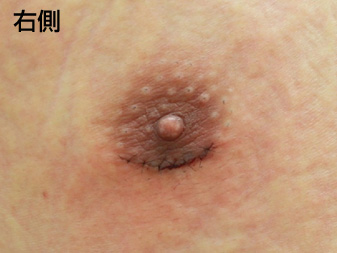 女性化乳房修正術症例№20手術翌日乳輪乳頭の状態右側
