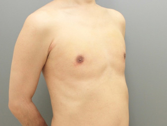 女性化乳房修正術症例№20、1週間後右斜め
