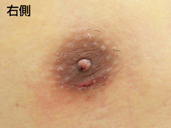 女性化乳房修正術症例№20、1週間後乳輪乳頭の状態右側