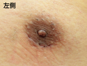 女性化乳房修正術症例№20、1週間後乳輪乳頭の状態左側