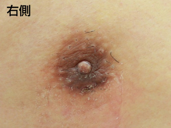 女性化乳房修正術症例№20、2週間後乳輪乳頭の状態右側