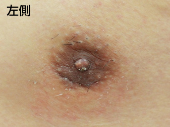 女性化乳房修正術症例№20、2週間後乳輪乳頭の状態左側