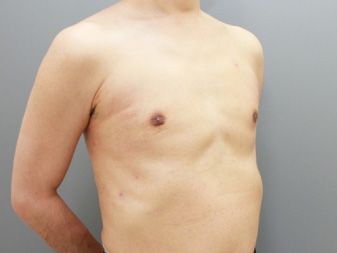 女性化乳房修正術症例№20、1か月後右斜め