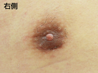 女性化乳房修正術症例№20、1ヶ月後乳輪乳頭の状態右側
