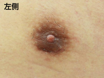 女性化乳房修正術症例№20、1ヶ月後乳輪乳頭の状態左側