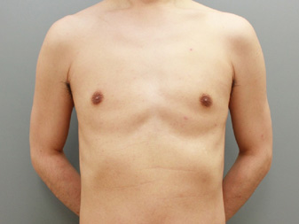 女性化乳房修正術症例№20、3か月後正面