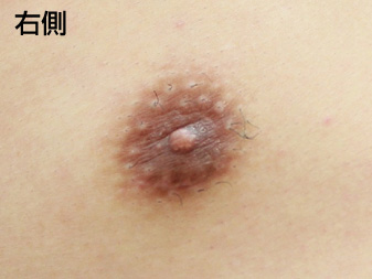 女性化乳房修正術症例№20、3ヶ月後乳輪乳頭の状態右側