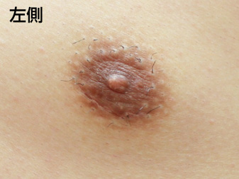 女性化乳房修正術症例№20、3ヶ月後乳輪乳頭の状態左側