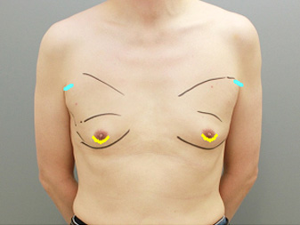 女性化乳房修正術症例№21術前手術デザイン正面