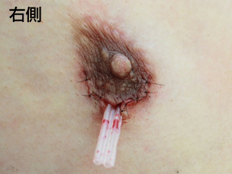 女性化乳房修正術症例№21手術直後右側ドレーン挿入の状態