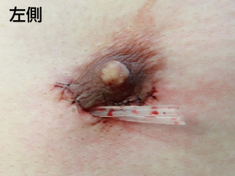 女性化乳房修正術症例№21手術直後左側ドレーン挿入の状態