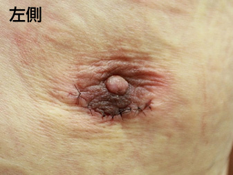 女性化乳房修正術症例№21手術翌日乳輪乳頭の状態左側