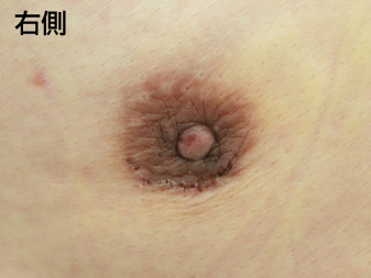 女性化乳房修正術症例№21、1週間後乳輪乳頭の状態右側