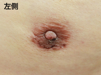 女性化乳房修正術症例№21、1週間後乳輪乳頭の状態左側