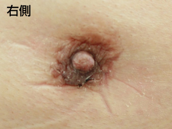 女性化乳房修正術症例№21、2週間後乳輪乳頭の状態右側