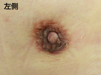 女性化乳房修正術症例№21、2週間後乳輪乳頭の状態左側