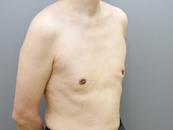 女性化乳房修正術症例№21、3か月後右斜め