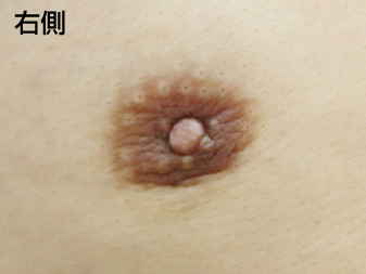 女性化乳房修正術症例№21、3ヶ月後乳輪乳頭の状態右側