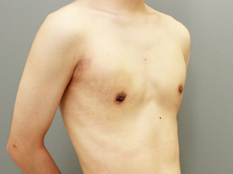 女性化乳房修正術症例№05手術後1週間右斜め