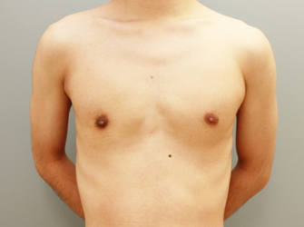 女性化乳房修正術症例№05手術後3ヶ月正面