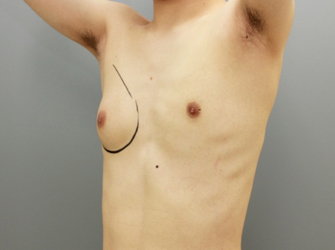 女性化乳房修正術症例№05手術デザイン左斜め