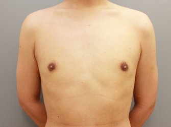 女性化乳房修正術症例№06手術後２ヶ月正面