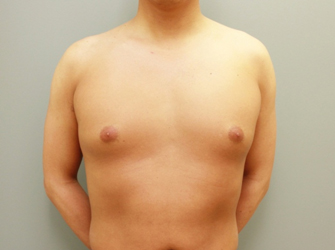 女性化乳房修正術症例№07術前正面