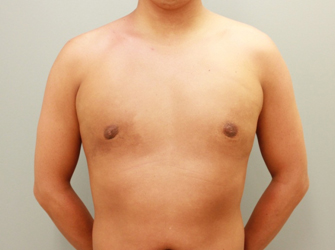 女性化乳房修正術症例№07手術後１ヶ月正面