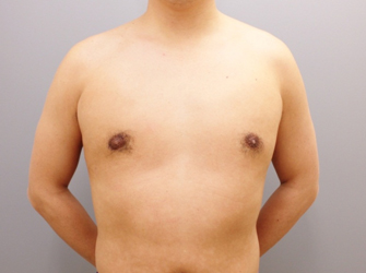 女性化乳房修正術症例№07手術後４ヶ月正面