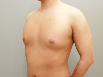 女性化乳房修正術症例№07術前左斜め