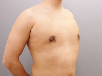 女性化乳房修正術症例№07手術後４ヶ月右斜め