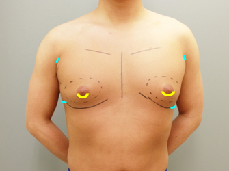 女性化乳房修正術症例№07手術デザイン正面