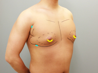 女性化乳房修正術症例№07手術デザイン右斜め