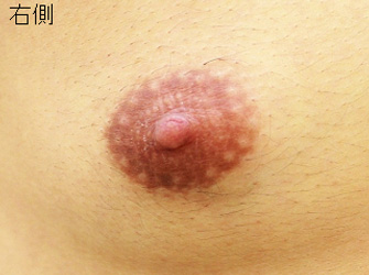女性化乳房修正術症例№09術前右接写