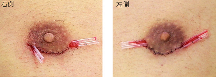 女性化乳房修正術症例№09手術直後ドレーン挿入の状態
