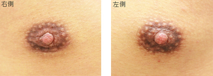 女性化乳房修正術症例№09、3ヶ月後傷跡