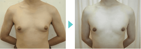 女性化乳房 症例１