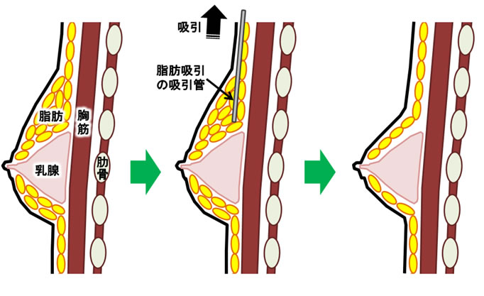 女性化乳房手術方法のイメージ３
