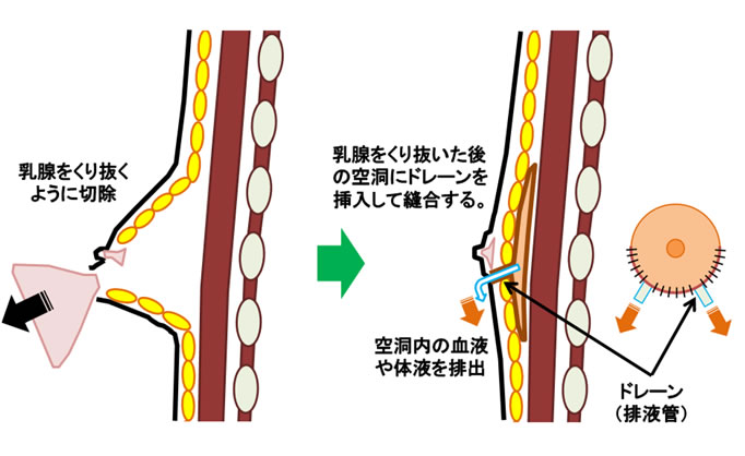 女性化乳房手術方法のイメージ５