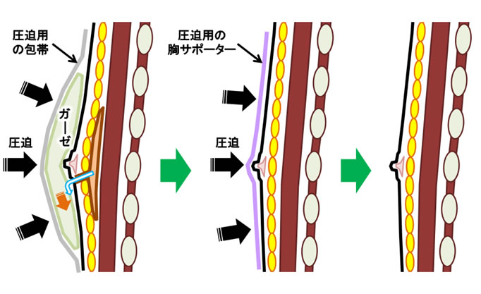 女性化乳房手術方法のイメージ６