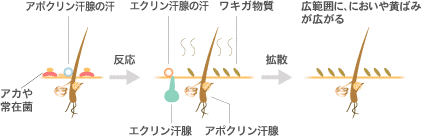 ワキガ わきが 多汗症 イメージ