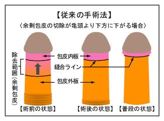 旧式の包茎手術図