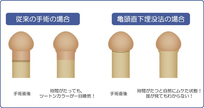 従来の包茎手術と亀頭直下埋没法による包茎手術